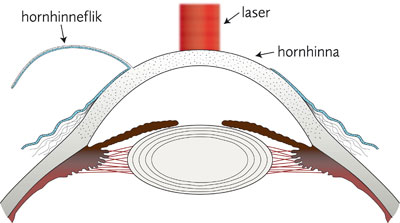 närsynthet, översynthet och astigmatism – kan opereras med laser
