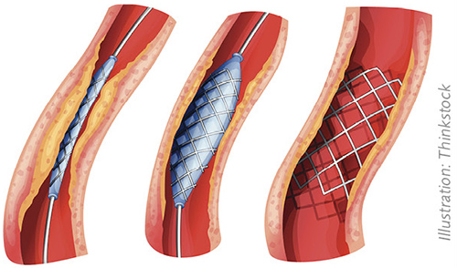 Figure 1 Narrowing in a coronary artery is caused by arteriosclerotic plaque, which can be displaced mechanically by a metal stent expanded by means of a balloon.