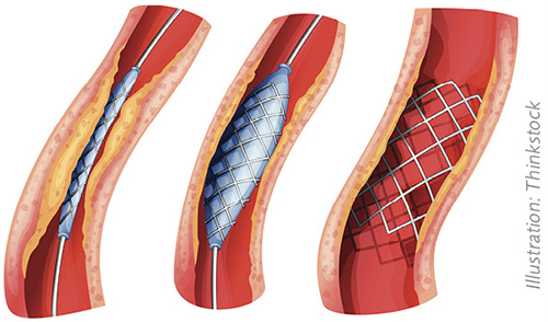 Figur 1 En förträngning i ett kranskärl utgörs av ett arteriosklerotiskt plack som kan tryckas undan mekaniskt av ett metallstent som expanderas med hjälp av en ballong.