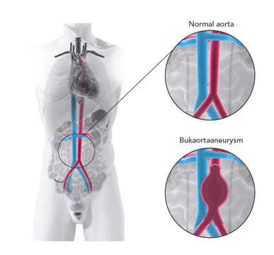 Beskrivning av bukaortaaneurysm