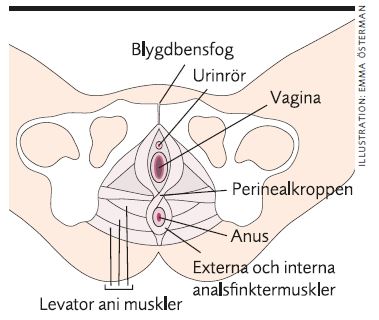 illustration bristning vid förlossning