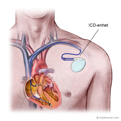 Illustration ICD-enhet i kropp