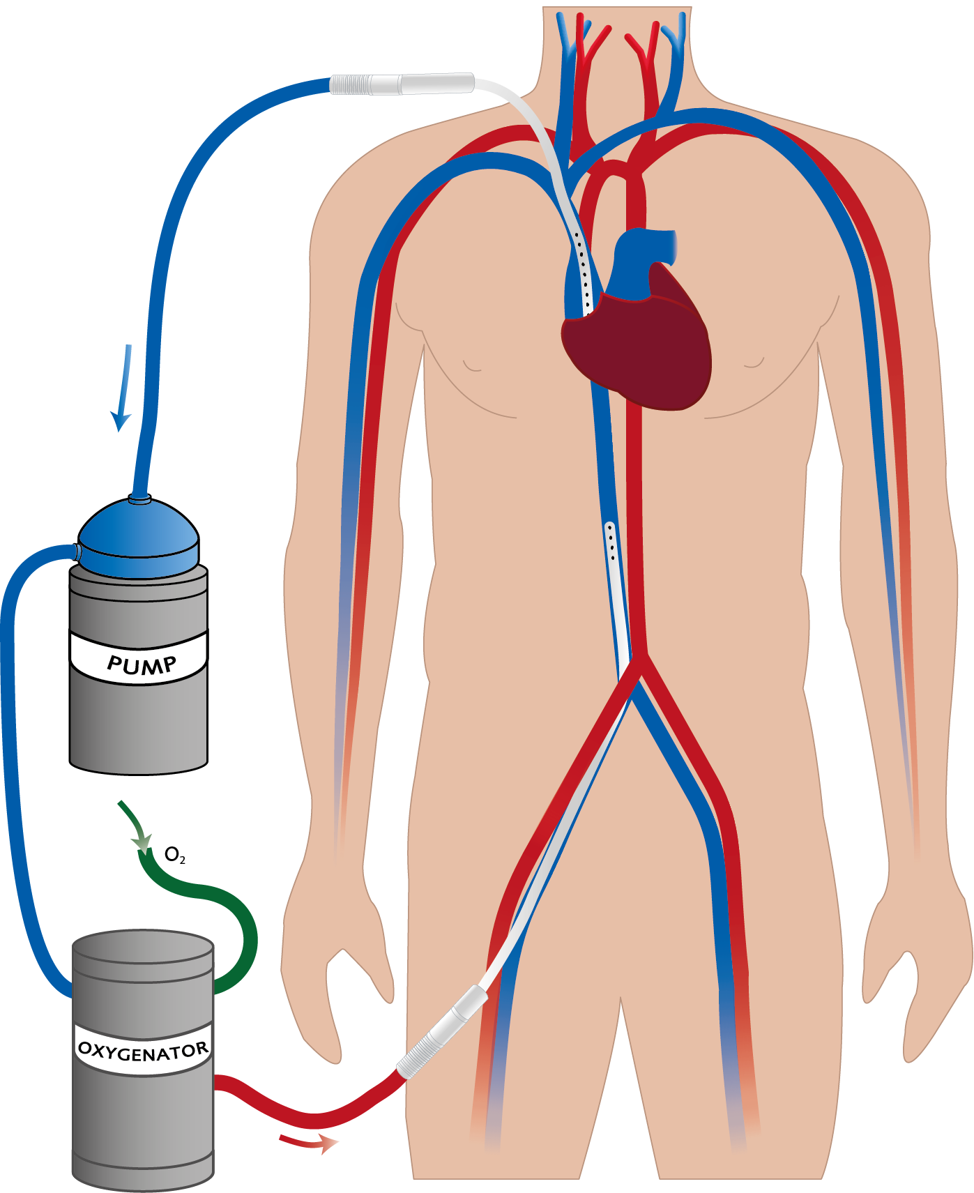  Blodet leds från en central ven till en ECMO-apparat där det passerar ett membran som tillför syre till och avlägsnar koldioxid från blodet. Det syresatta blodet pumpas sedan tillbaka till patientens kretslopp genom en ven. Illustration