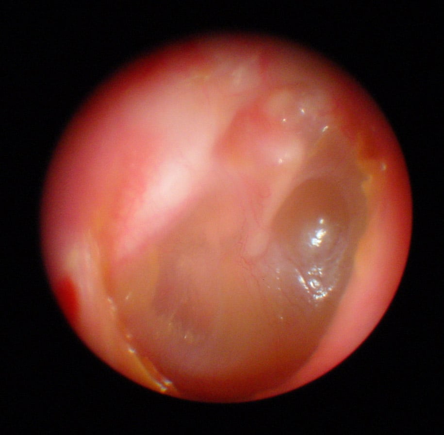 Sekretorisk otitis media