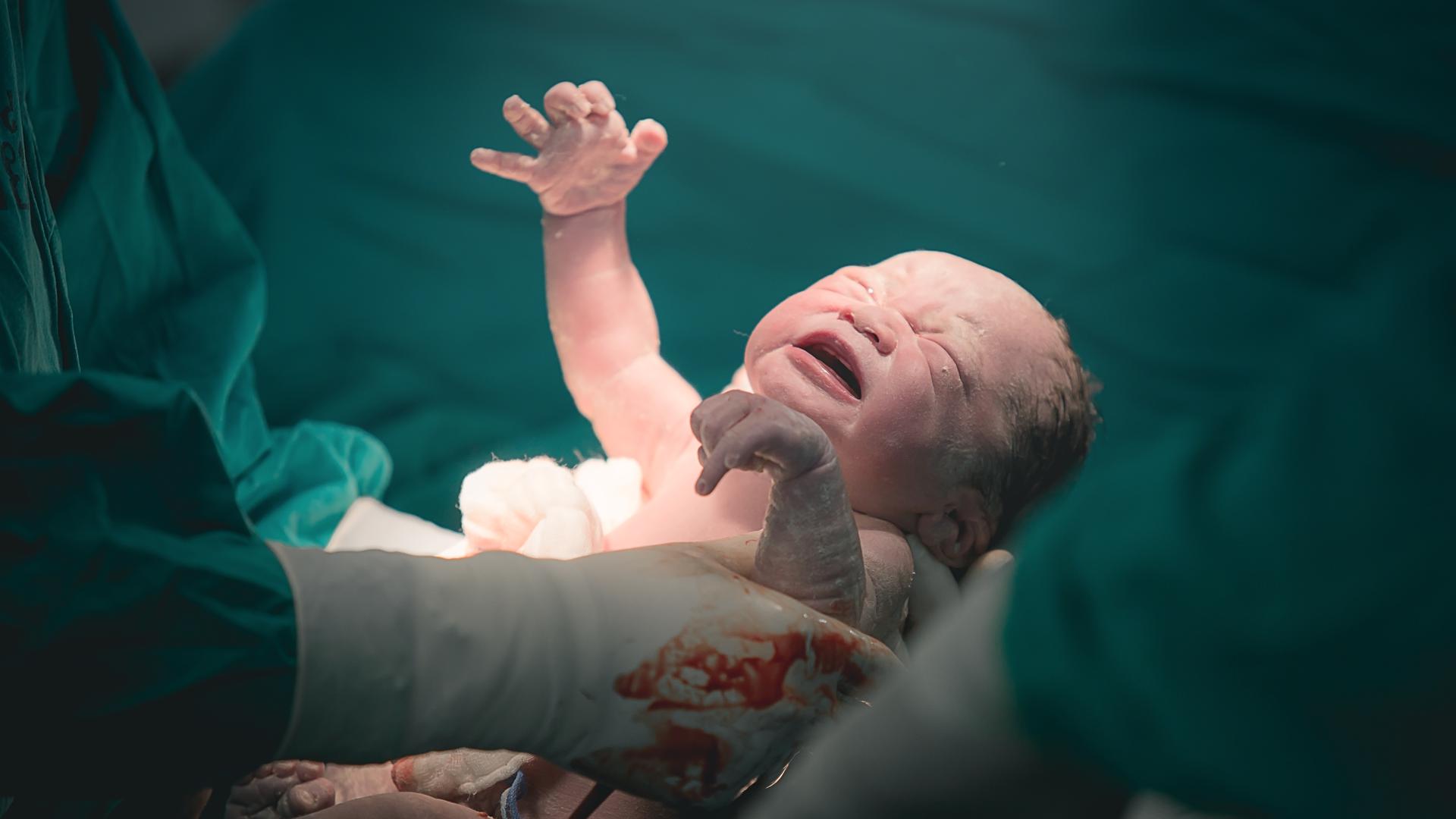 Kejsarsnitt. Läkare och sjuksköterska tar ut en nyfödd bebis från mammas mage.