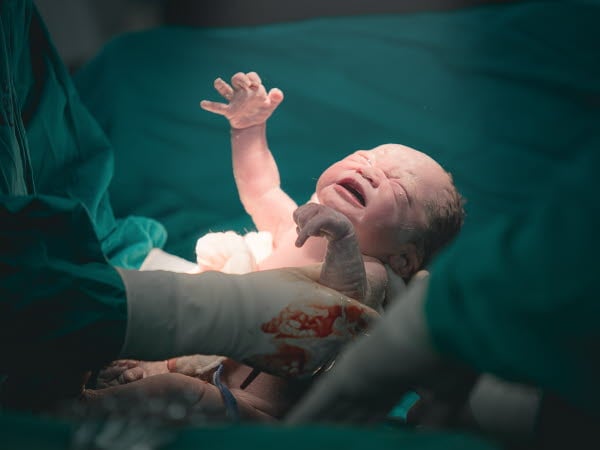 Kejsarsnitt. Läkare och sjuksköterska tar ut en nyfödd bebis från mammas mage.